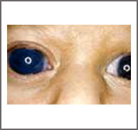 Congenital Glaucoma