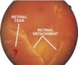 What is the Retina